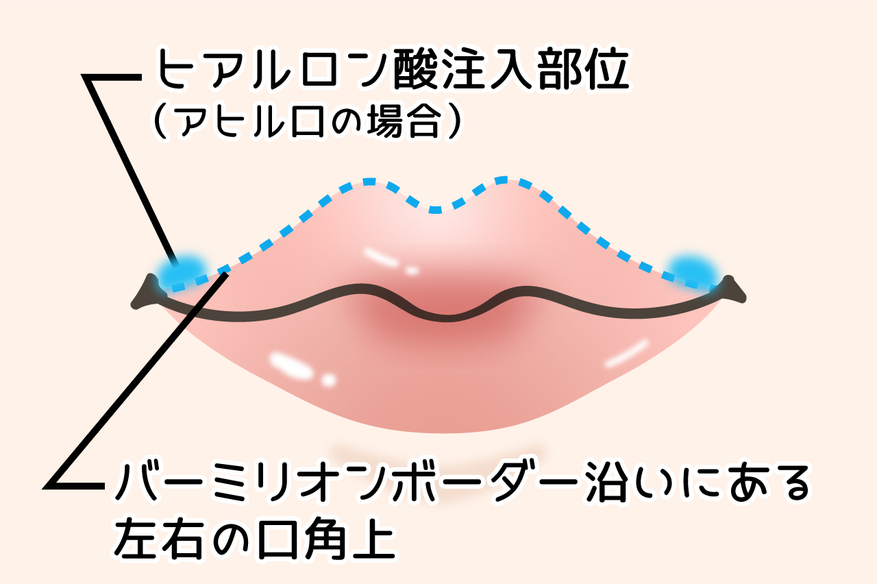 アヒル口で愛嬌のあるくちびるに